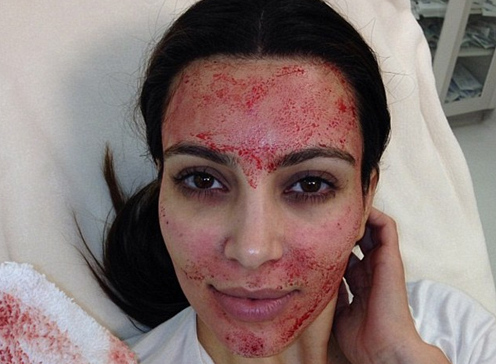 Kim Kardashian Vampire facial details revealed