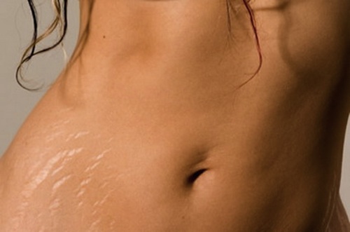 Is it possible to get rid of stretch marks?